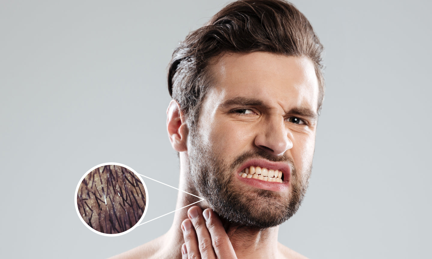 ingrown-beard-hair-on-bearded-man